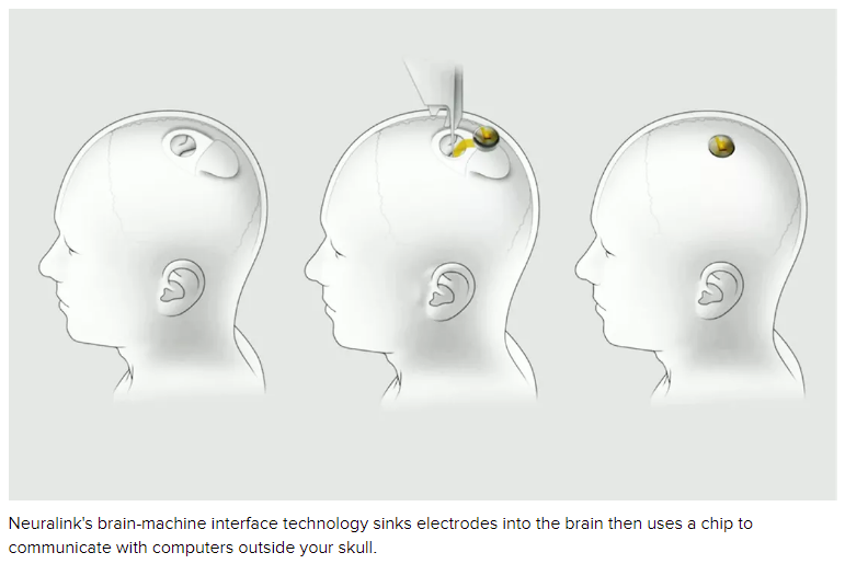 Neuralink implant scheme